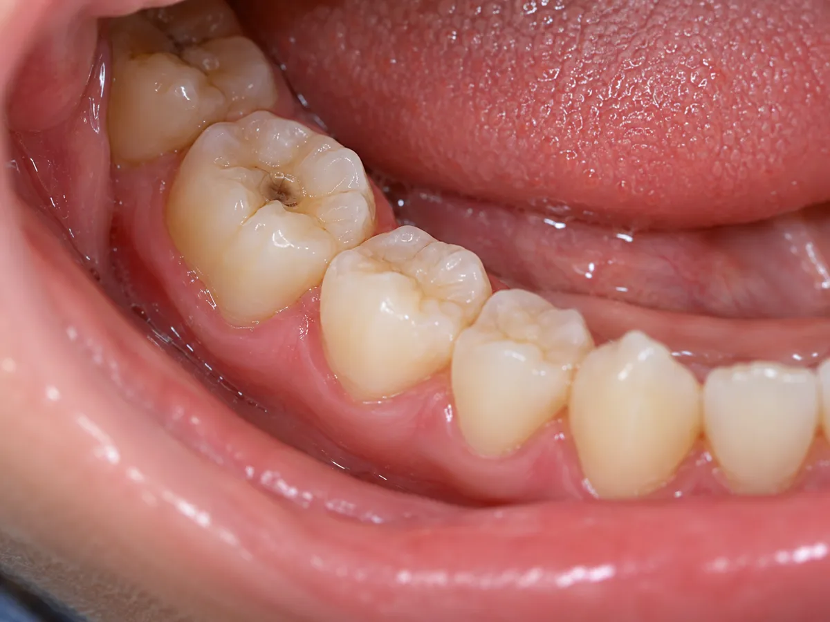Before a tooth-colored restoration of a back tooth