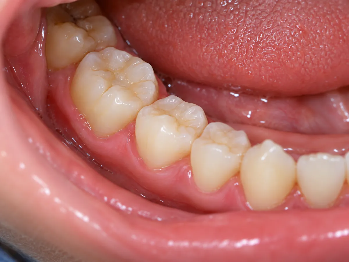 After a tooth-colored restoration of a back tooth